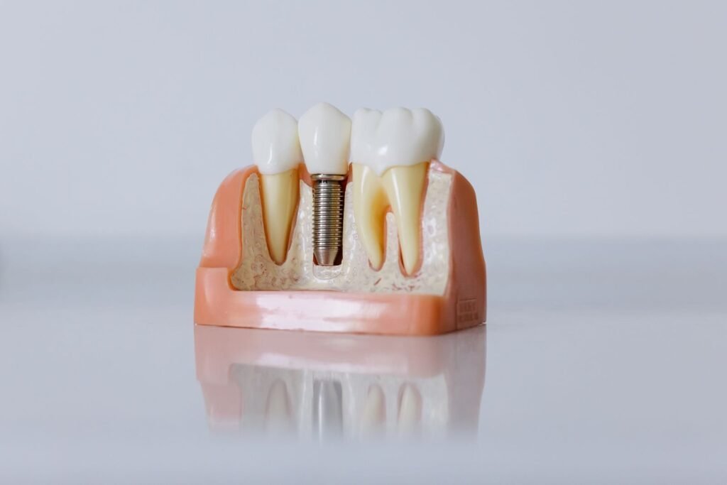 Dental implant model showing a titanium implant in the jaw — dental implants in Dombivli
